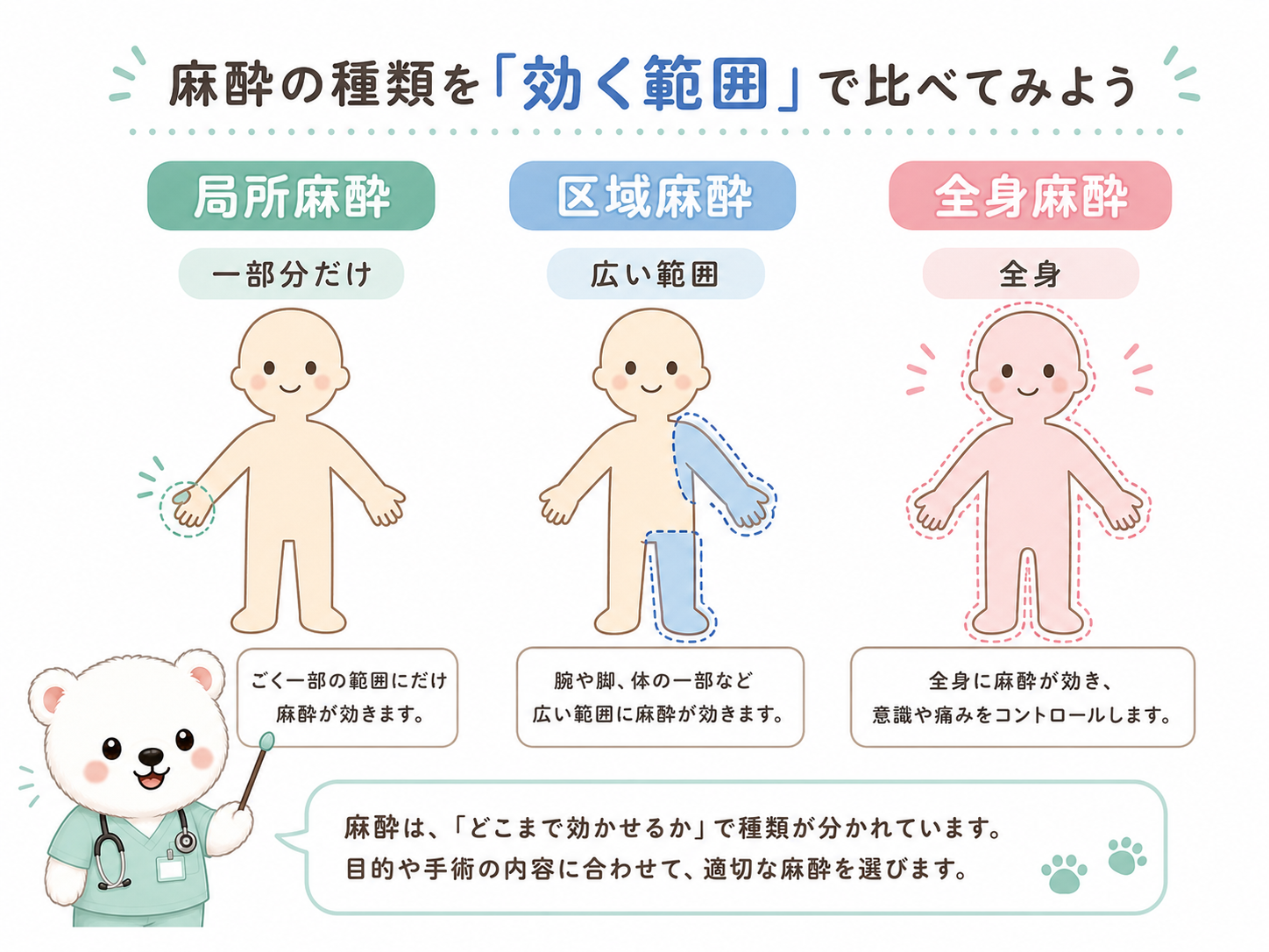 局所麻酔、区域麻酔、全身麻酔を効く範囲で比較したイラスト