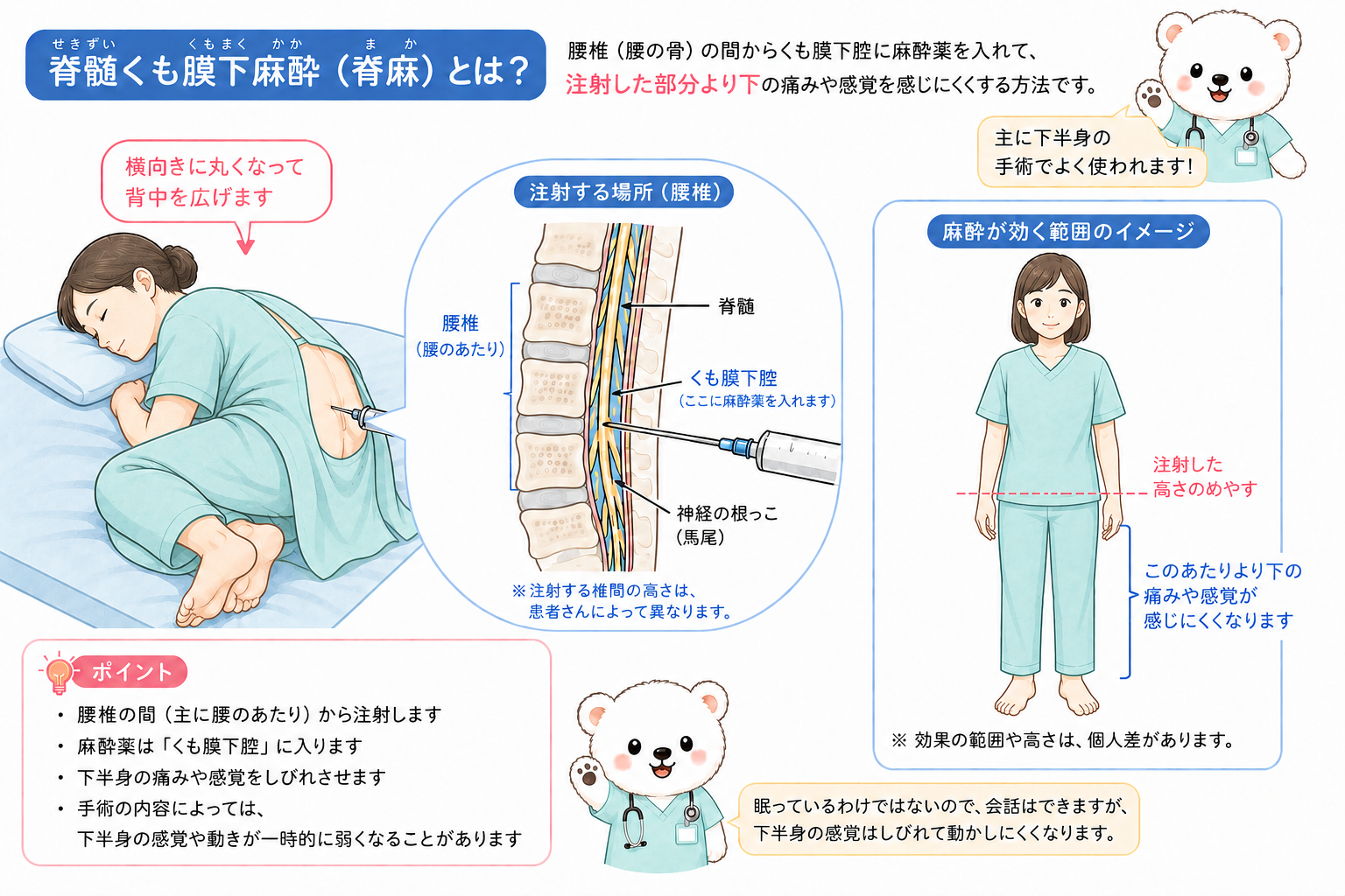 横向きに丸まった女性患者の腰から麻酔薬を入れ、下半身に麻酔が効くことを示した脊髄くも膜下麻酔のイラスト