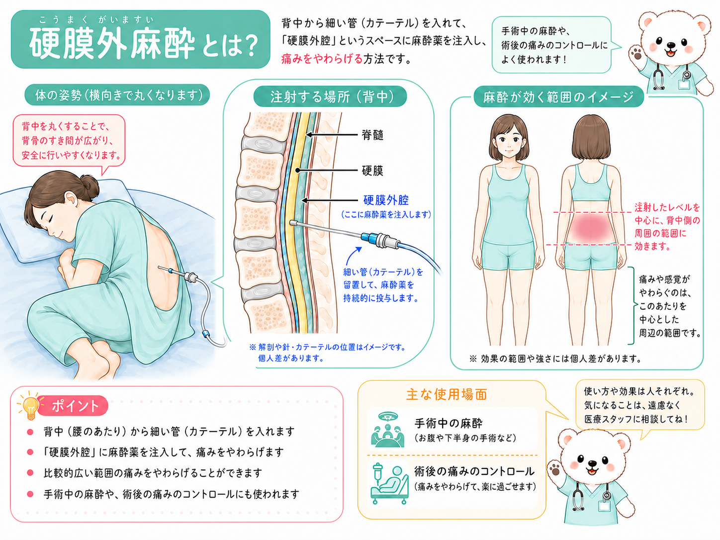 横向きの女性患者の背中から硬膜外腔へ細い管を入れ、挿入部周辺に麻酔が効くことを示した硬膜外麻酔のイラスト